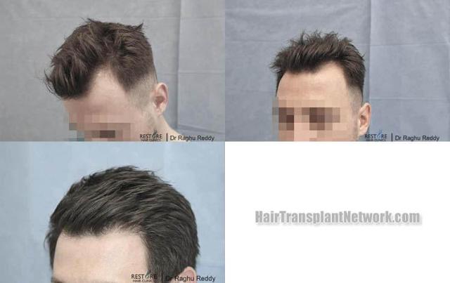 Hair restoration procedure before and after pictures