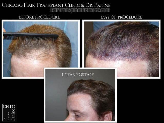 Hair transplantation surgery before and after pictures