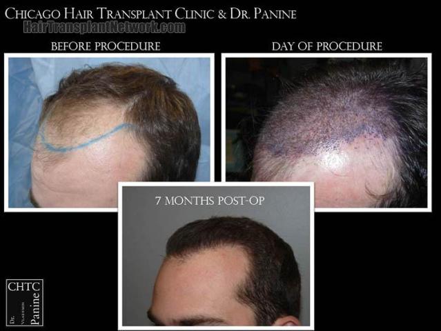 Hair transplantation surgery before and after images