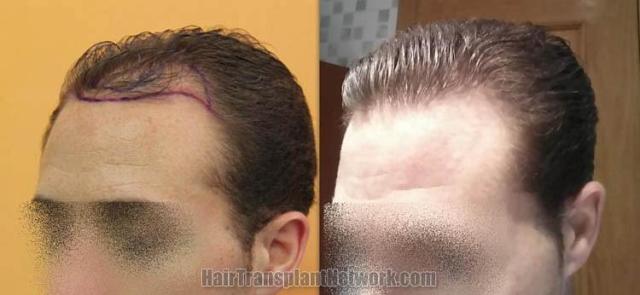 Hair transplantation surgery before and after pictures