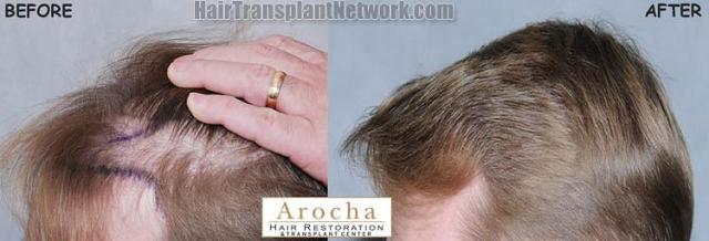 Hair transplantation surgery before and after images