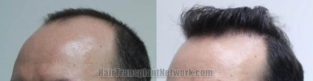 Hair transplantation surgery before and after pictures