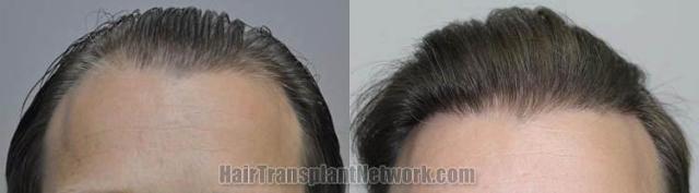 Hair restoration procedure before and after results