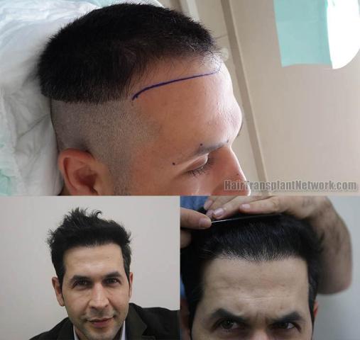 Hair restoration surgery before and after photographs