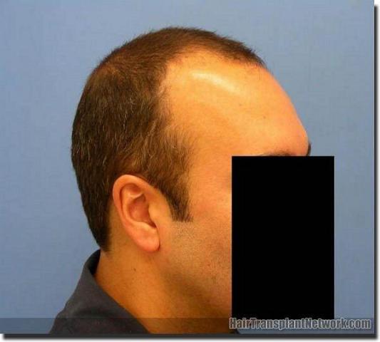 Hair restoration procedure results