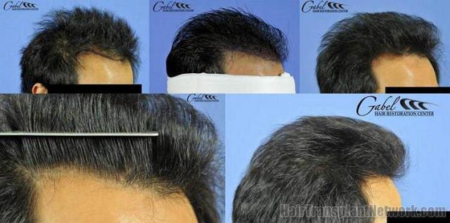 Hair transplant procedure - Right side views.