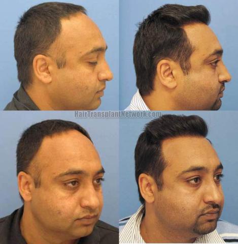 Hair transplant before and after pictures