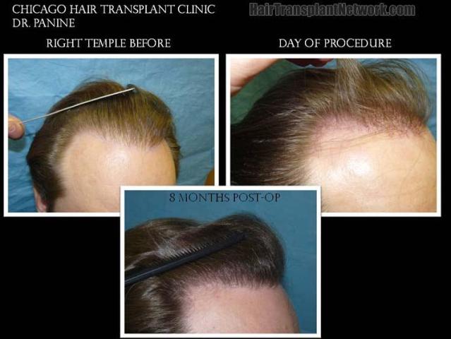 Hair transplantation surgery before and after images