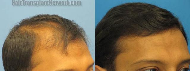 Hair transplantation surgery before and after images