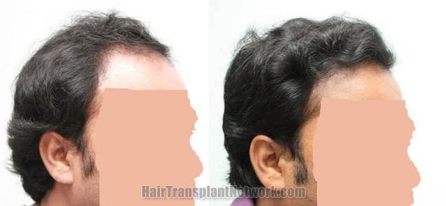 Hair restoration procedure before and after results