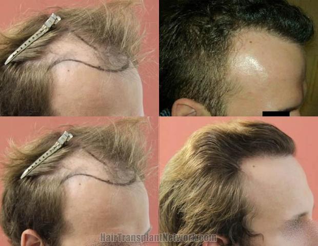 Hair restoration procedure before and after pictures