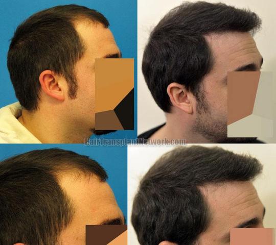 Hair restoration procedure before and after results