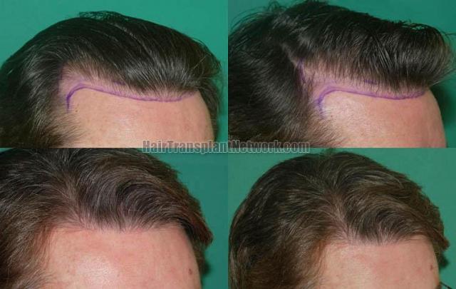 Hair restoration procedure before and after results