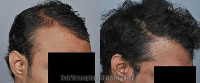 Hair restoration procedure before and after results