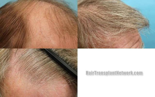 Hair transplantation surgery before and after pictures