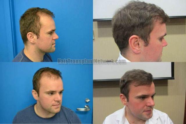 Hair restoration procedure before and after results