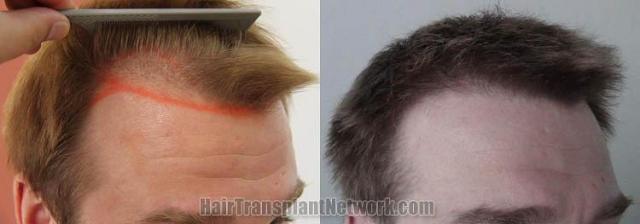 Hair transplantation surgery before and after pictures