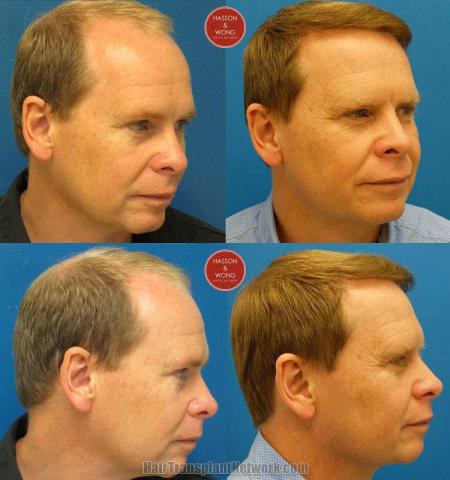 Hair restoration procedure before and after pictures