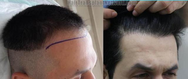 Hair transplantation surgery before and after photos