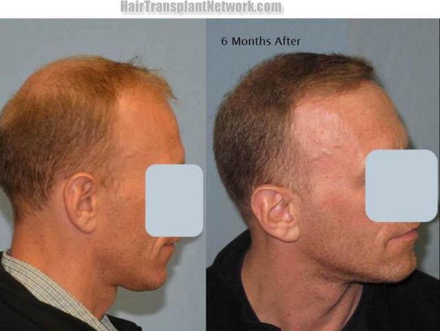 Hair transplantation surgery before and after images