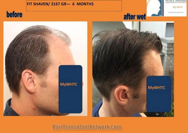 Hair transplantation surgery before and after images