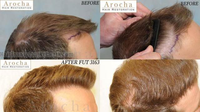 Hair transplantation surgery before and after images