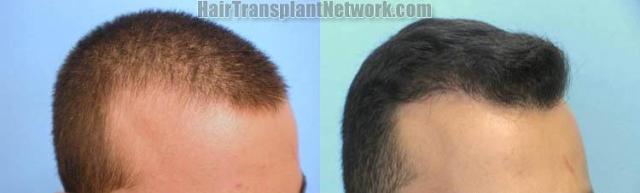 Hair transplantation surgery before and after pictures