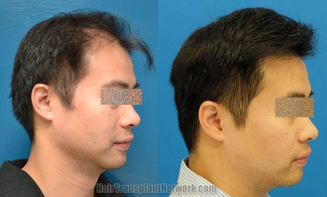 Hair transplantation surgery before and after photos