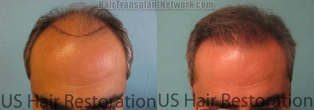 Hair restoration procedure before and after pictures