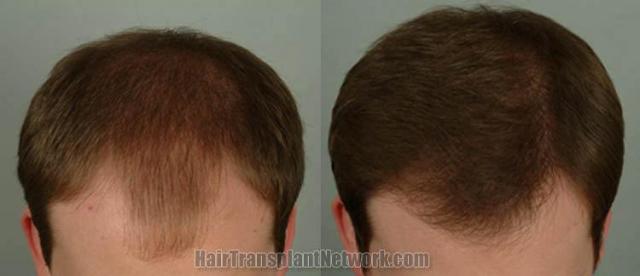 Top view - Before and after surgical hair replacement