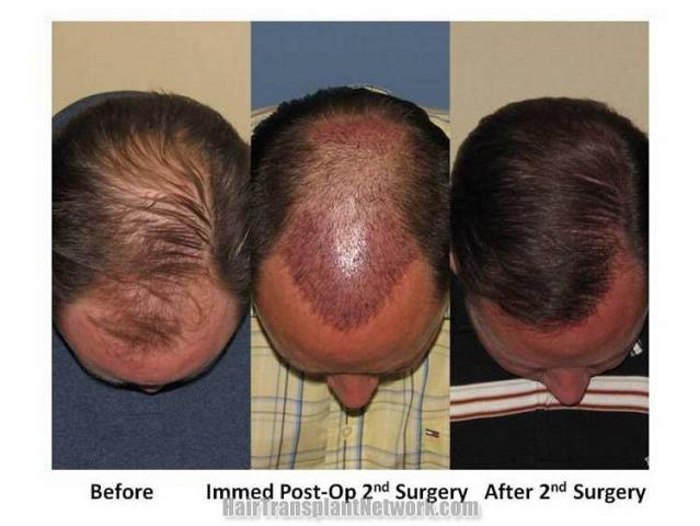 Hair restoration results - Top view- Two sessions