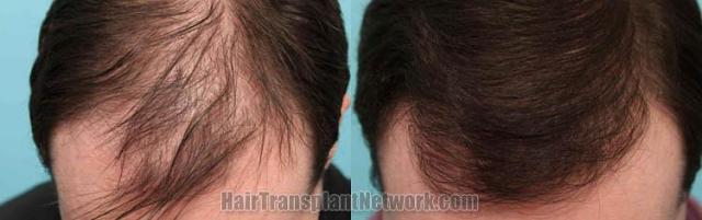 Hair restoration procedure before and after results