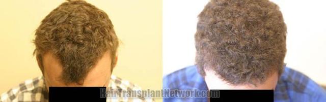 Hair transplantation surgery before and after photos