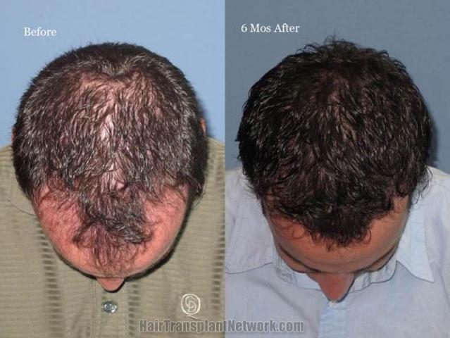 Hair restoration procedure before and after pictures