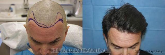 Hair transplantation surgery before and after photos