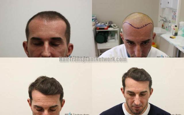 Hair transplantation surgery before and after photos