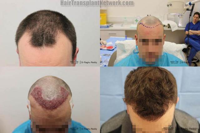 Top view - Before and after surgical hair replacement