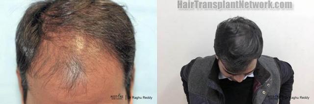 Hair transplantation surgery before and after photos