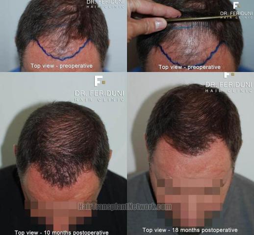 Hair transplantation surgery before and after photos