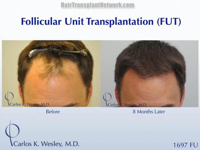 Hair transplantation surgery before and after photos