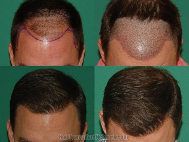 Hair transplantation surgery before and after photos