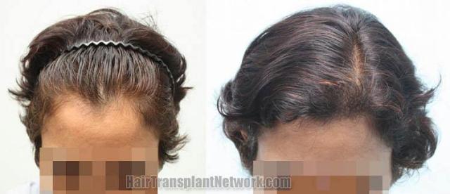 Hair transplantation surgery before and after photos