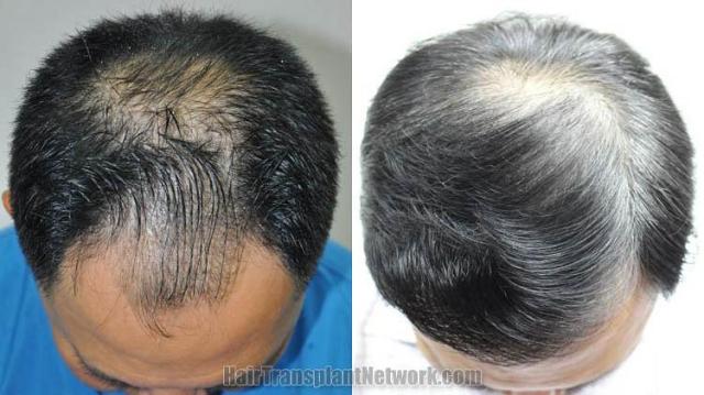 Top view before and after hair restoration results