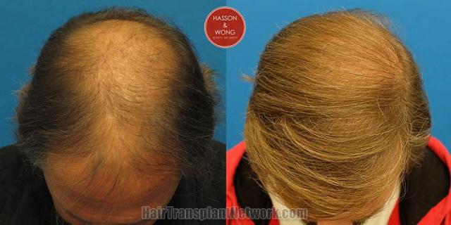 Hair transplantation surgery before and after photos