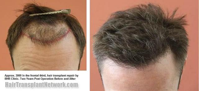 Hair transplantation surgery before and after photos