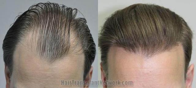 Hair transplantation surgery before and after photos