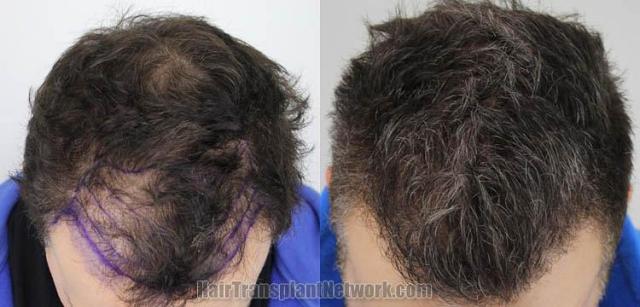 Top view before and after hair restoration results