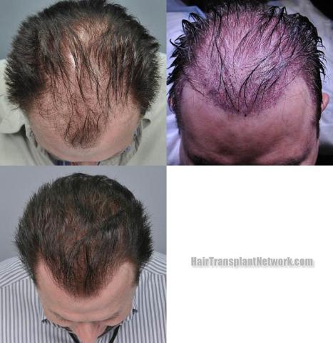 Hair transplantation surgery before and after photos