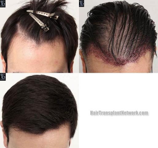 Hair transplantation surgery before and after photos