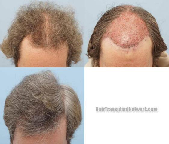 Hair restoration procedure before and after results